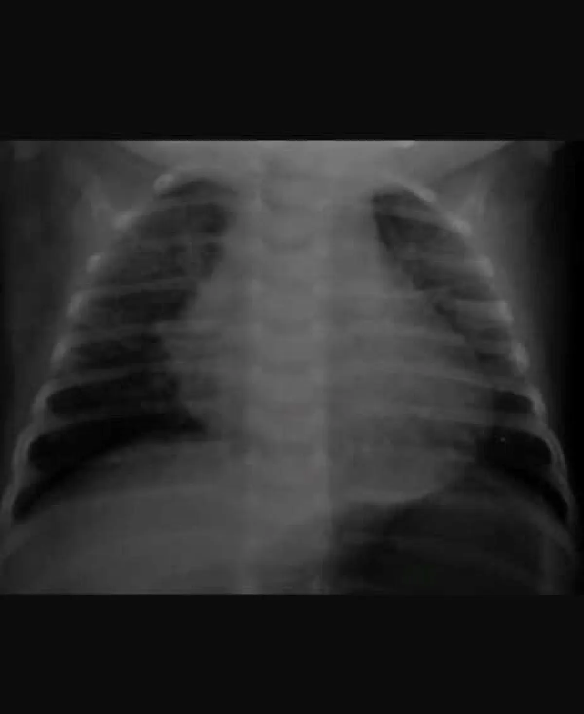 เตือนใจพ่อแม่สูบบุหรี่ ลูกน้อยป่วยหนักปอดติดเชื้อเพราะ "ควันบุหรี่"