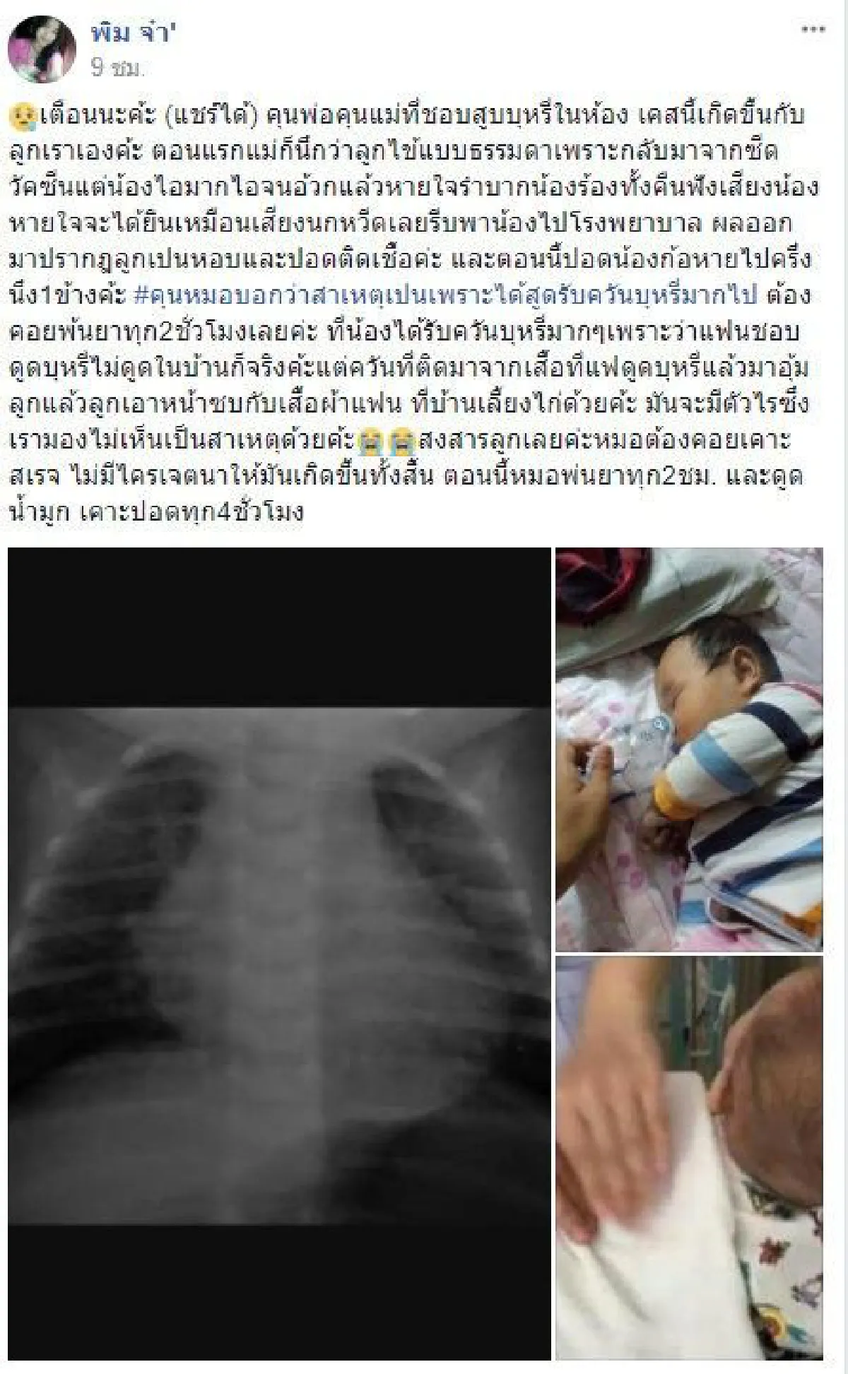 เตือนใจพ่อแม่สูบบุหรี่ ลูกน้อยป่วยหนักปอดติดเชื้อเพราะ "ควันบุหรี่"