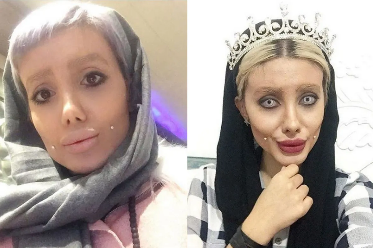 เงิบ! สาวอิหร่านรับ โกหกศัลยกรรม 50 ครั้งหวังเหมือน"โจลี่"