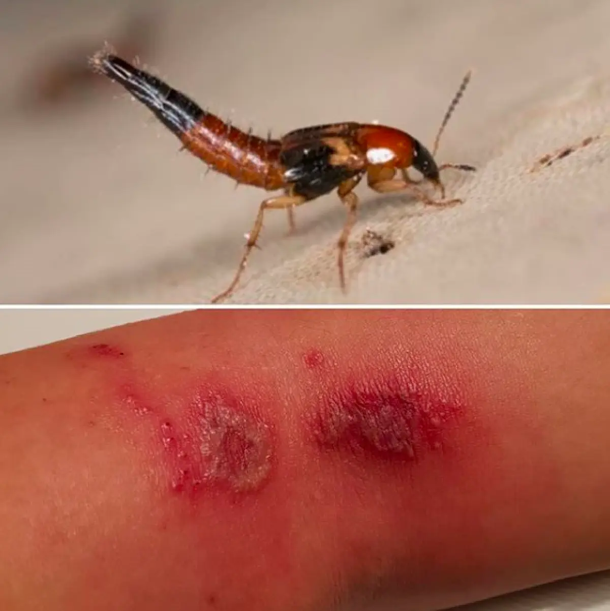 "หน่อย” โพสต์เตือน หลังโดน "แมลงก้นกระดก” กัด จนผิวหนังพุพอง