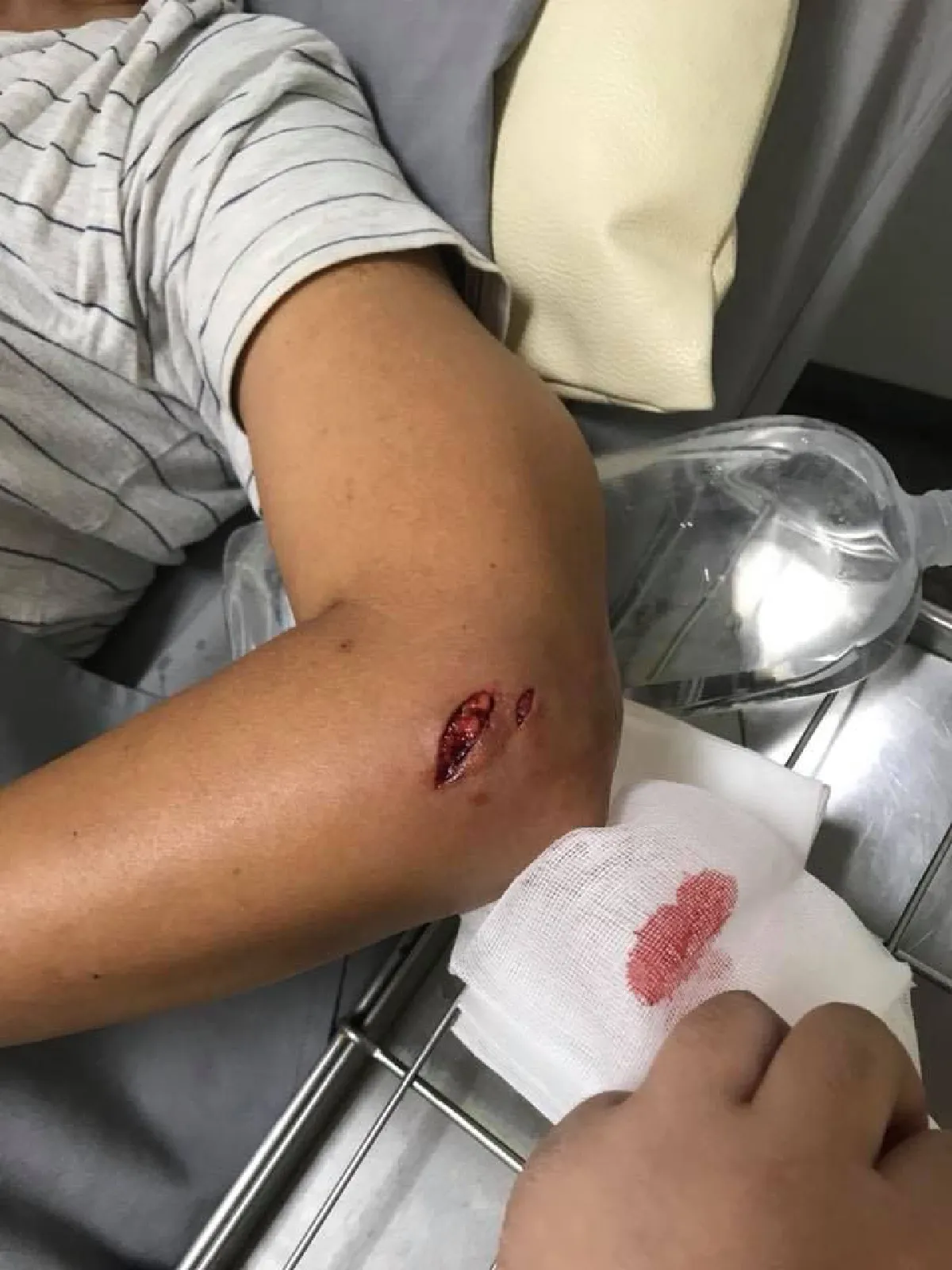 “สุนารี” ถูกพาส่งรพ. ด่วน! หลังโดนสุนัขที่บ้านกัดจนแผลเหวอะ
