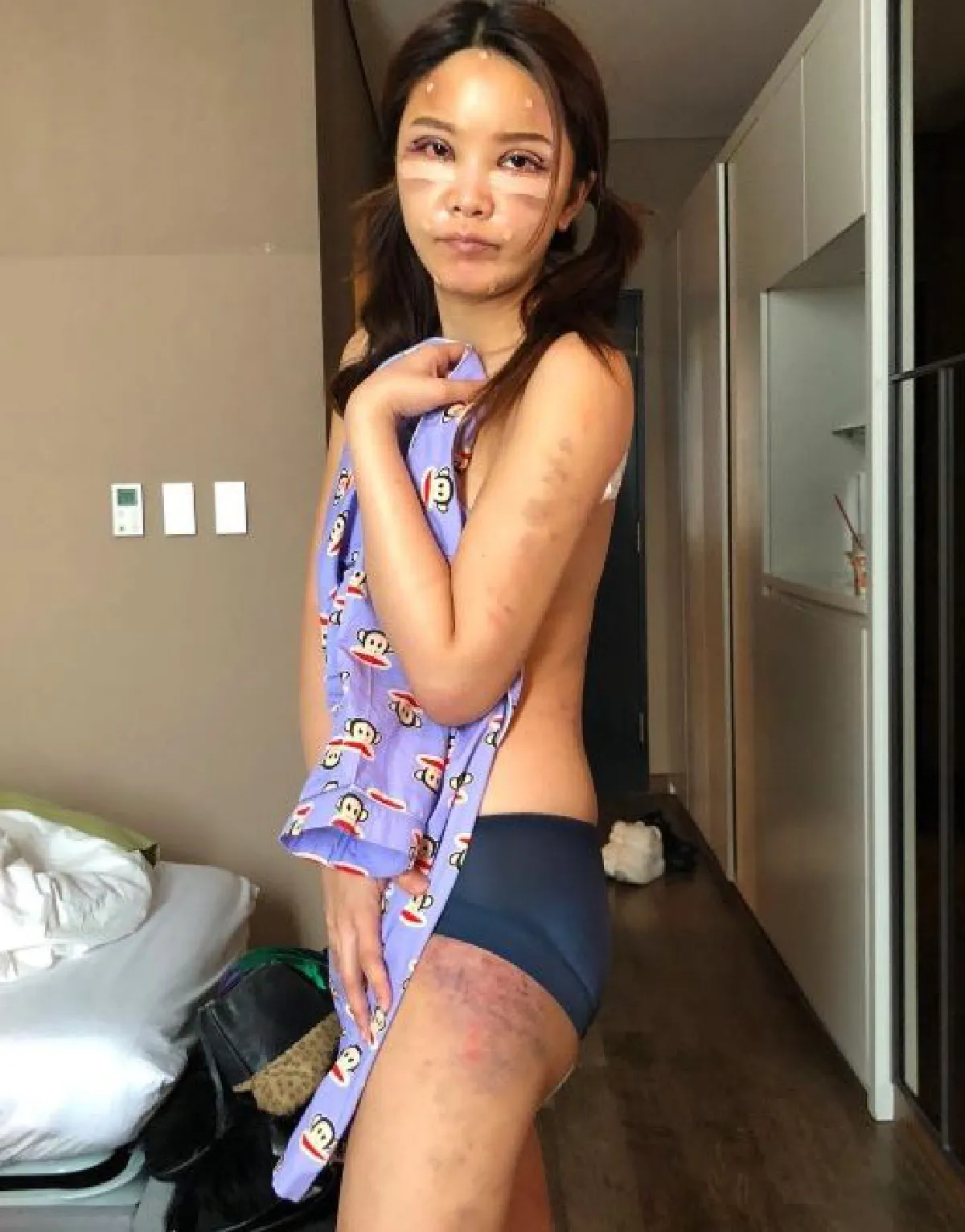 ช้ำทั้งหน้าระบมทั้งตัว! หญิงแย้ อัพเดทสภาพล่าสุด..หลังศัลยกรรมครั้งใหม่ (คลิป)