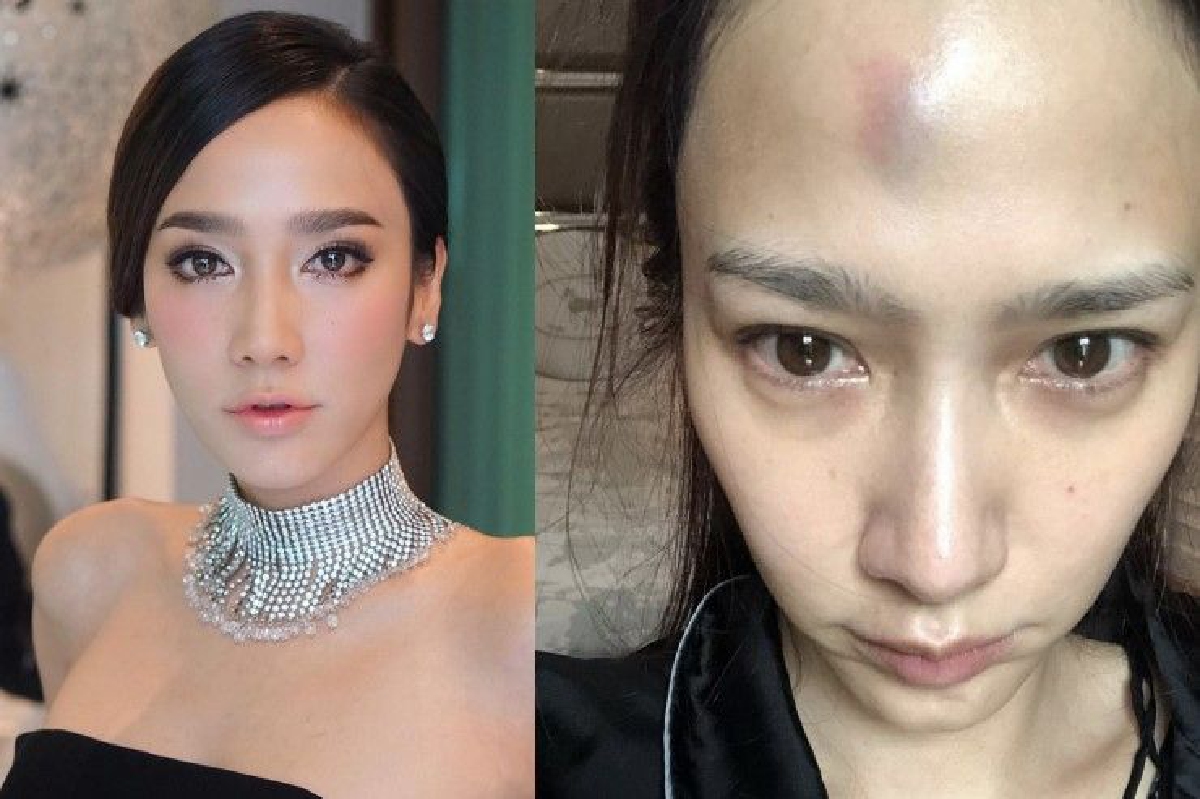 อั้ม พัชราภา ร้องไห้แต่เช้า! เผยสภาพหน้าผากเขียวช้ำโดนสันตู้ตกใส่ อั้ม พัชราภา ร้องไห้แต่เช้า! เผยสภาพหน้าผากเขียวช้ำโดนสันตู้ตกใส่