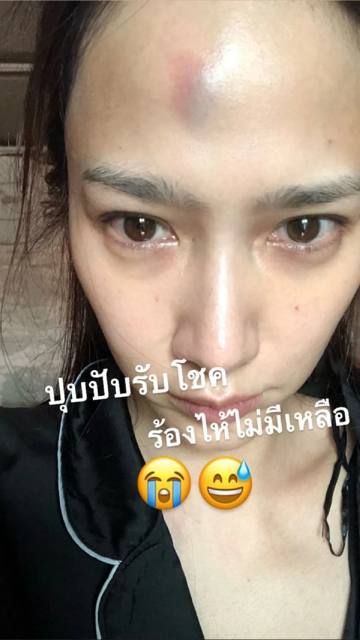 อั้ม พัชราภา ร้องไห้แต่เช้า! เผยสภาพหน้าผากเขียวช้ำโดนสันตู้ตกใส่