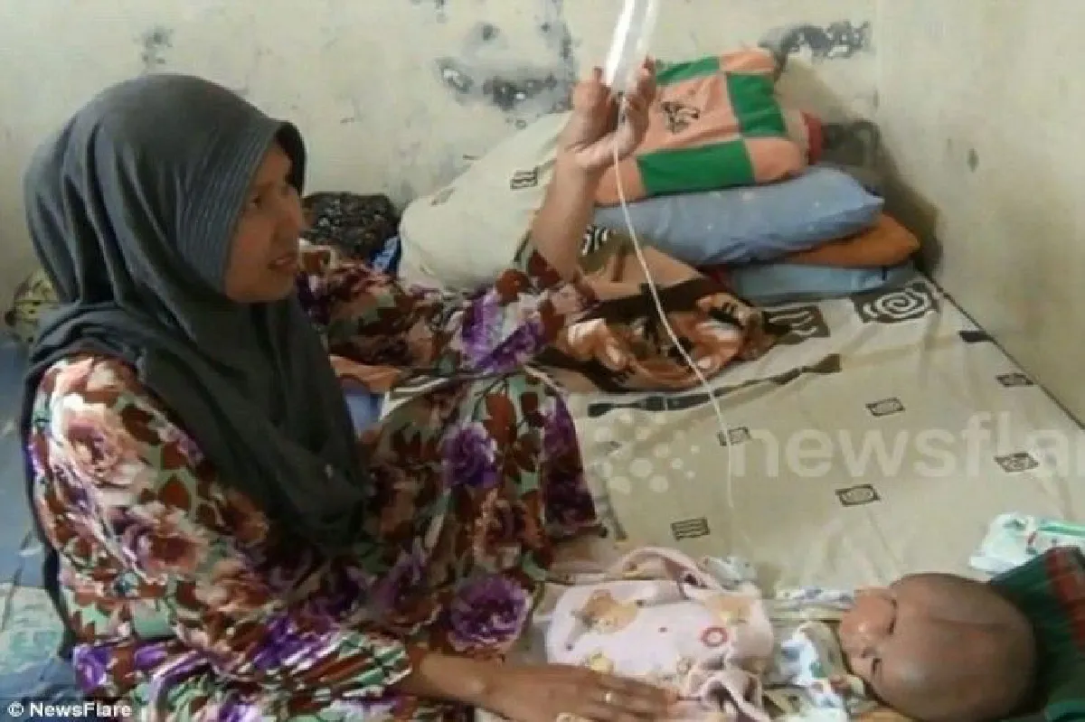 หญิงอินโดคลอดลูกเป็น"เด็กสองหัว"