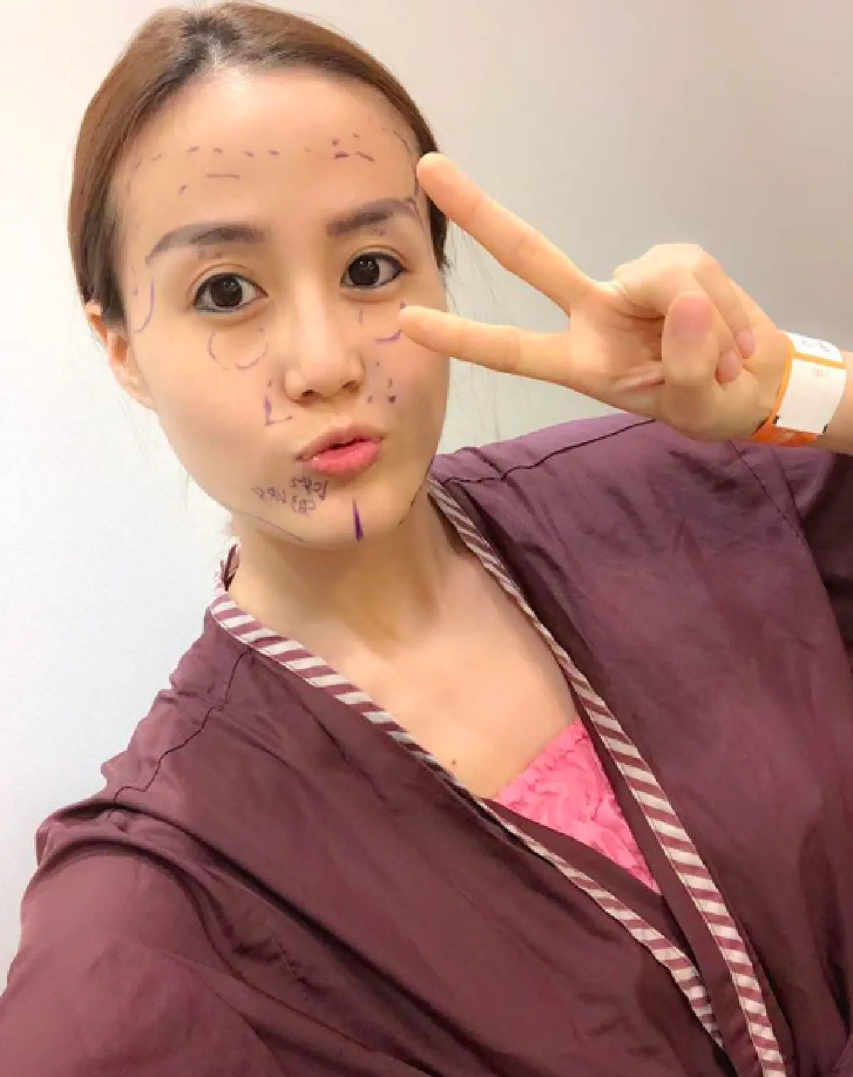 ปังมาก! “คุณ” หวานใจ “แจ๊ค แฟนฉัน” เพิ่มความสวยบินศัลยกรรมเกาหลี ตอนนี้ใบหน้าเรื่มเข้าที่