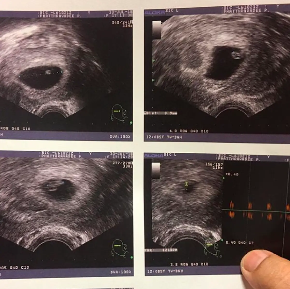 มาตามฝัน “หนูเล็ก” สุดแฮปปี้! ตั้งครรภ์ได้ 6 สัปดาห์ หลังเคยฝันว่าเก็บของได้