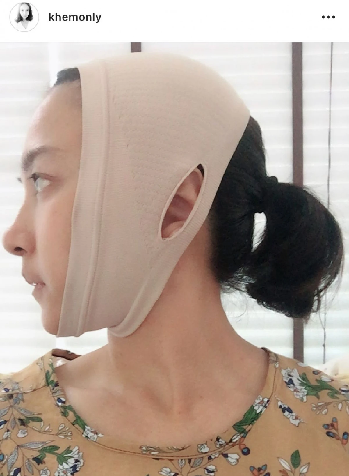 พึ่งมีดหมอครั้งแรก! “เข็ม กฤตธีรา” ผ่าตัดเก็บเหนียง ตอนนี้หน้าเรียวสวย