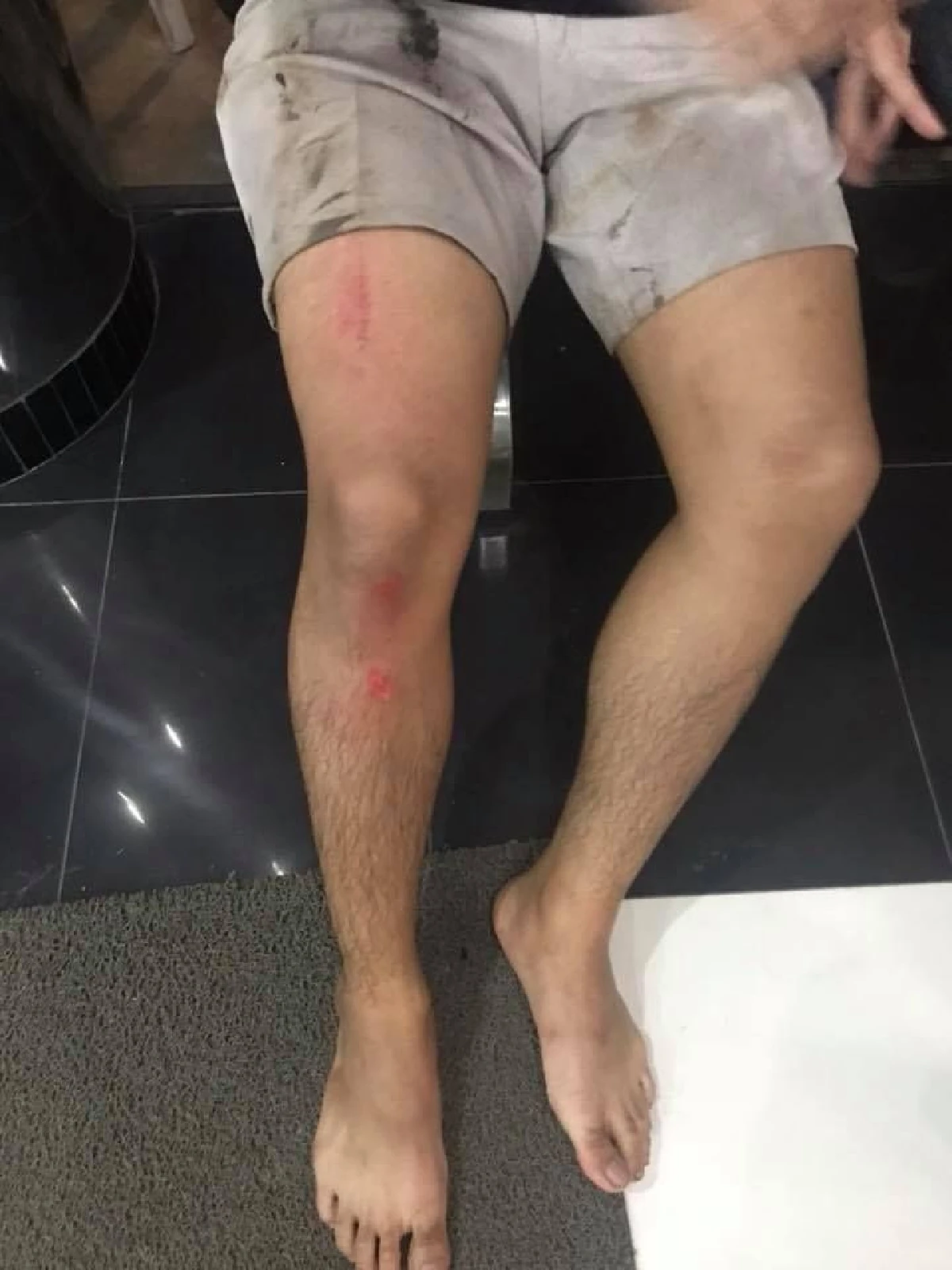 นศ.ธรรมศาสตร์ตกหลุมก่อสร้างถนน-หวั่นเด็กคนชราเป็นเหยื่อเหมือนตัวเอง