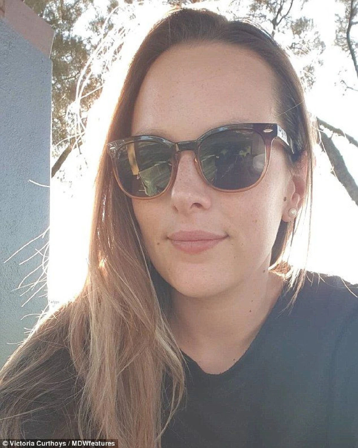 สปาปลาทำพิษ! สาวออสซี่ติดเชื้อถูกตัดนิ้วเท้าด้วน 5 นิ้ว