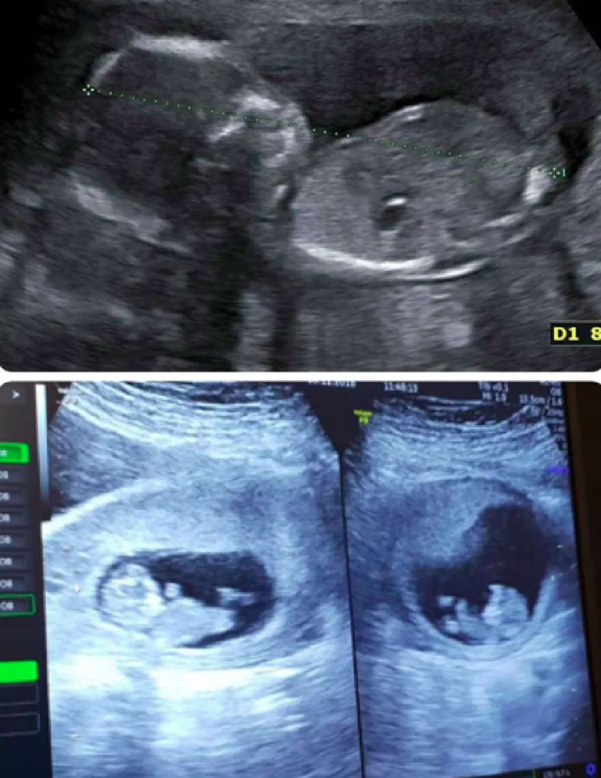 “บุ้ง ใบหยก” ภรรยา "เวฟ สาริน" เผยภาพอัลตราซาวด์ลูกในครรภ์ สุดแฮปปี้ได้ลูกชาย