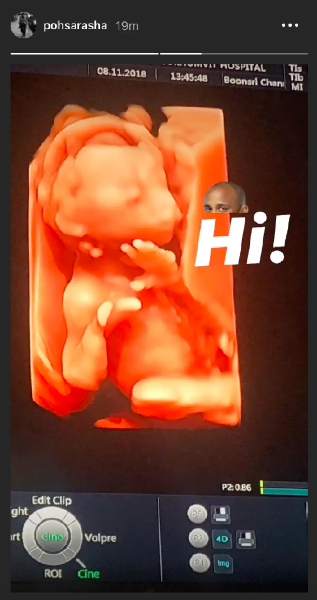 ภาพมาแล้ว “ป้อ” ภรรยา “เนม ปราการ” เผยรูปอัลตราซาวด์ลูกสาว