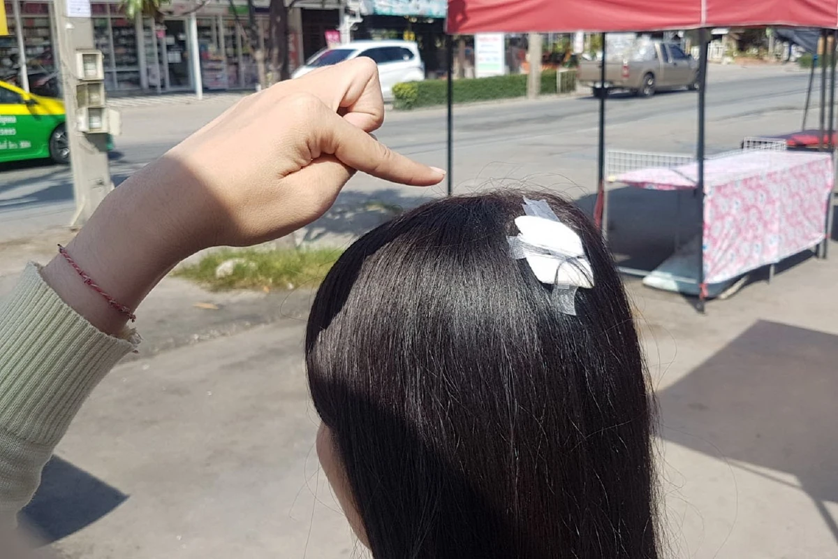 "ผมร่วงเป็นกระจุก"ประกายไฟจากหม้อแปลงไฟฟ้าหล่นใส่สาวพีอาร์