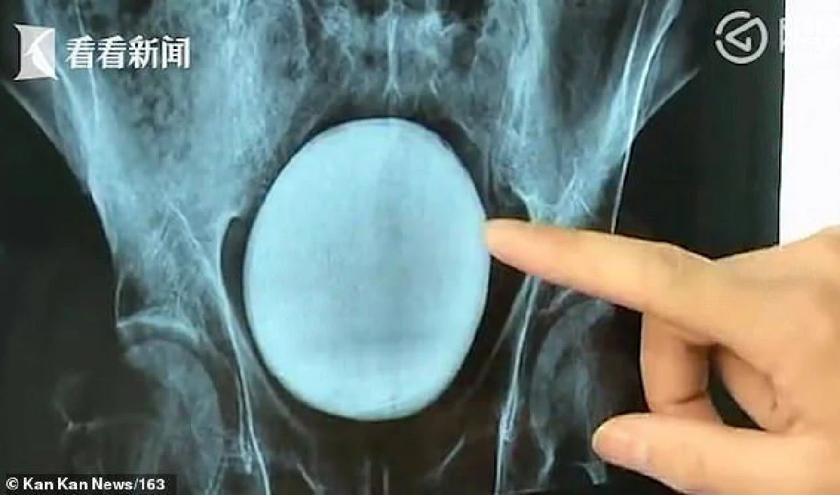 ชายจีนเล่นไพ่เพลิน กลั้นปัสสาวะจนเป็นนิ่วไซต์บิ๊ก