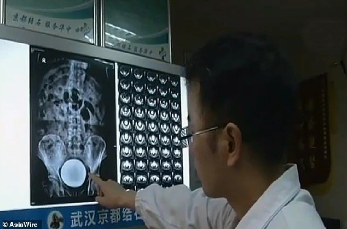 ชายจีนเล่นไพ่เพลิน กลั้นปัสสาวะจนเป็นนิ่วไซต์บิ๊ก