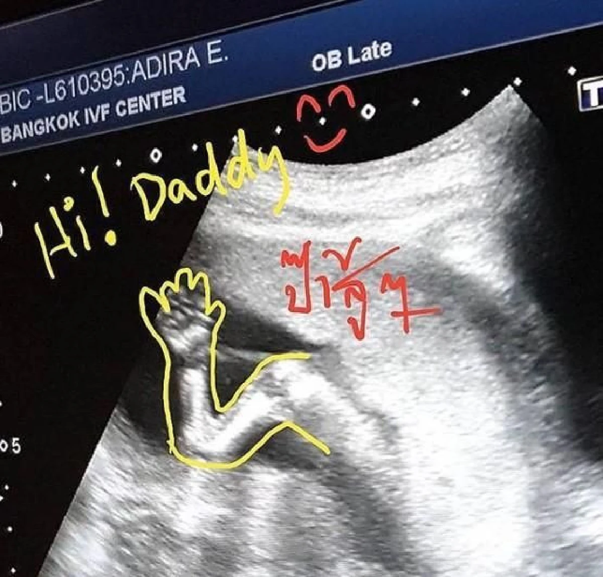 ไม่เห่อเท่าไหร่ “แทค” โชว์ภาพอัลตราซาวด์ลูกน้อย พร้อมกับตั้งชื่อลูกแล้ว