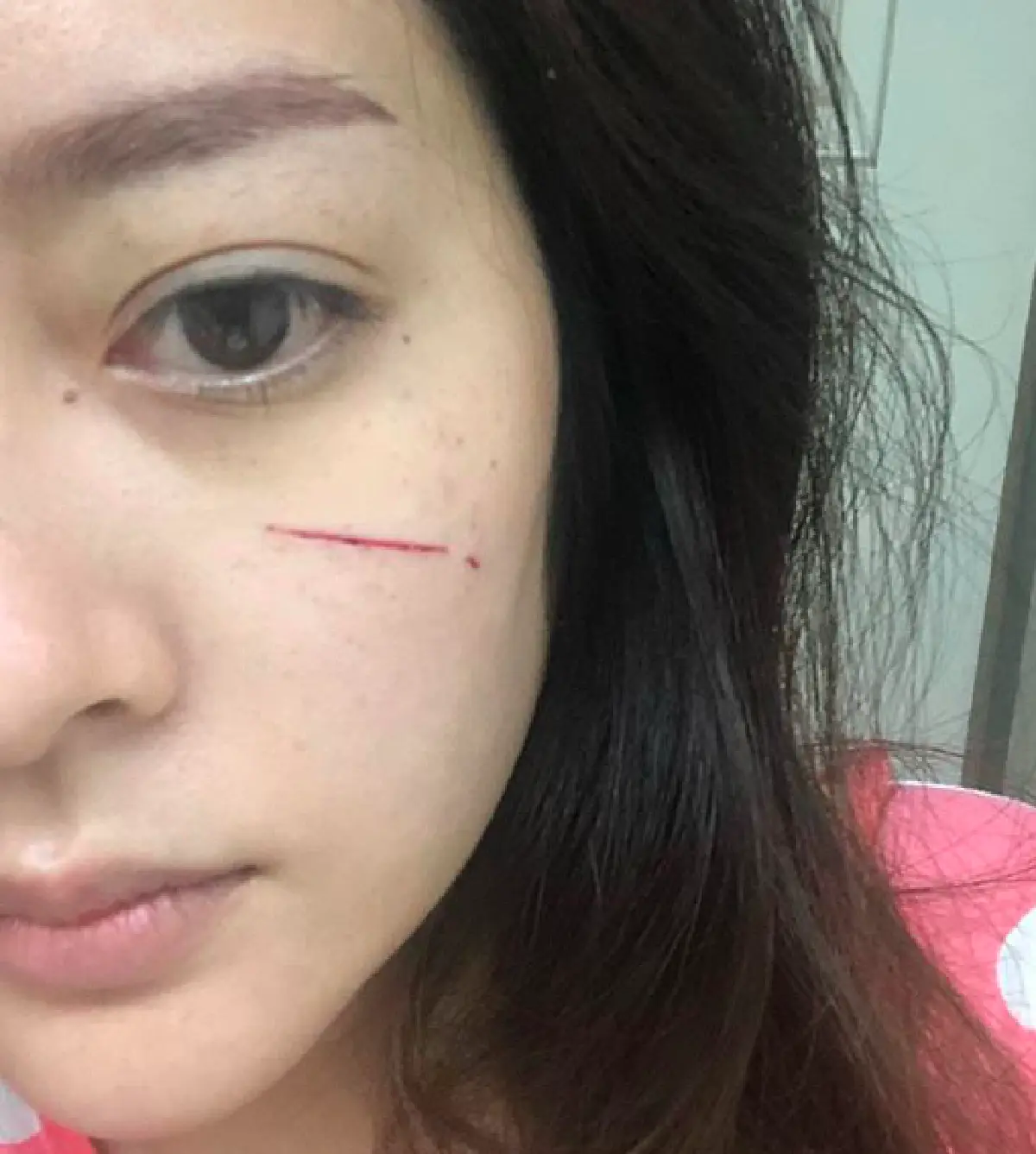 หวิดเสียโฉม! “แก้มบุ๋ม” ถูกแมวข่วนหน้า เลือดไหลอาบแก้ม