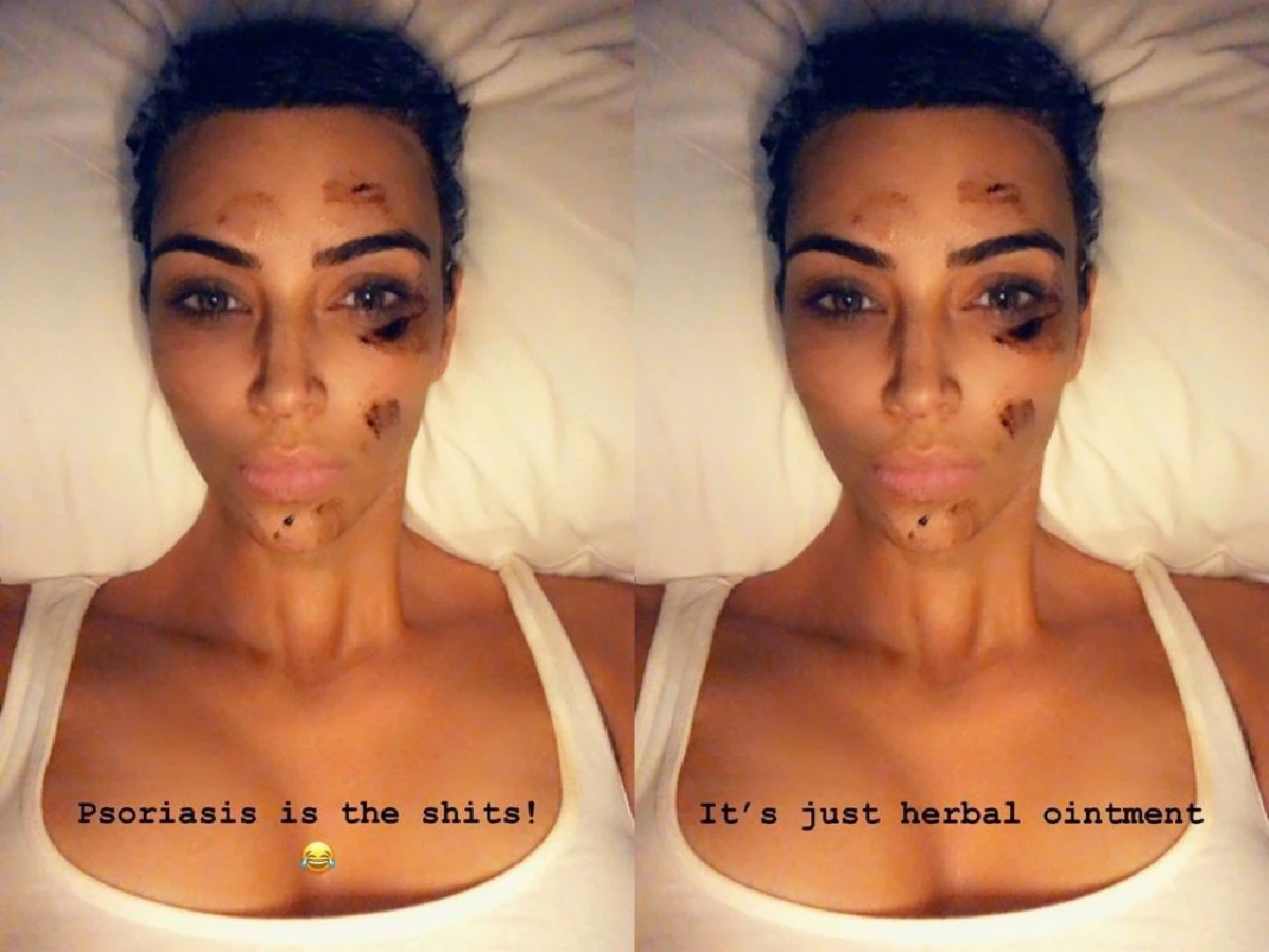 "คิม คาร์เดเชียน” ประสบปัญหาโรคสะเก็ดเงิน หลังถูกปาปารัซซี่ถ่ายภาพ แล้วมีคนมาวิจารณ์ว่าผิวไม่ดี