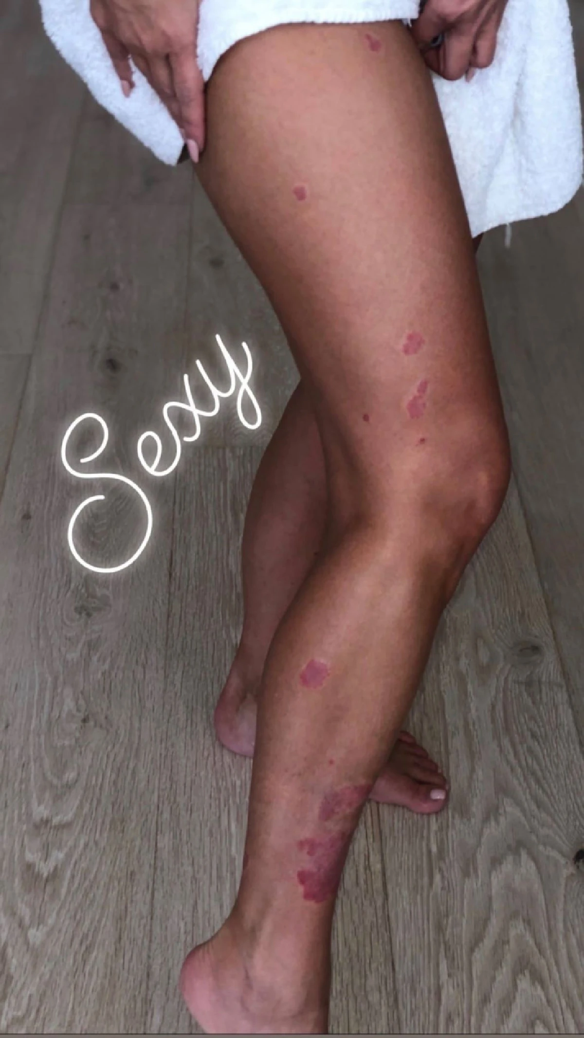 "คิม คาร์เดเชียน” ประสบปัญหาโรคสะเก็ดเงิน หลังถูกปาปารัซซี่ถ่ายภาพ แล้วมีคนมาวิจารณ์ว่าผิวไม่ดี