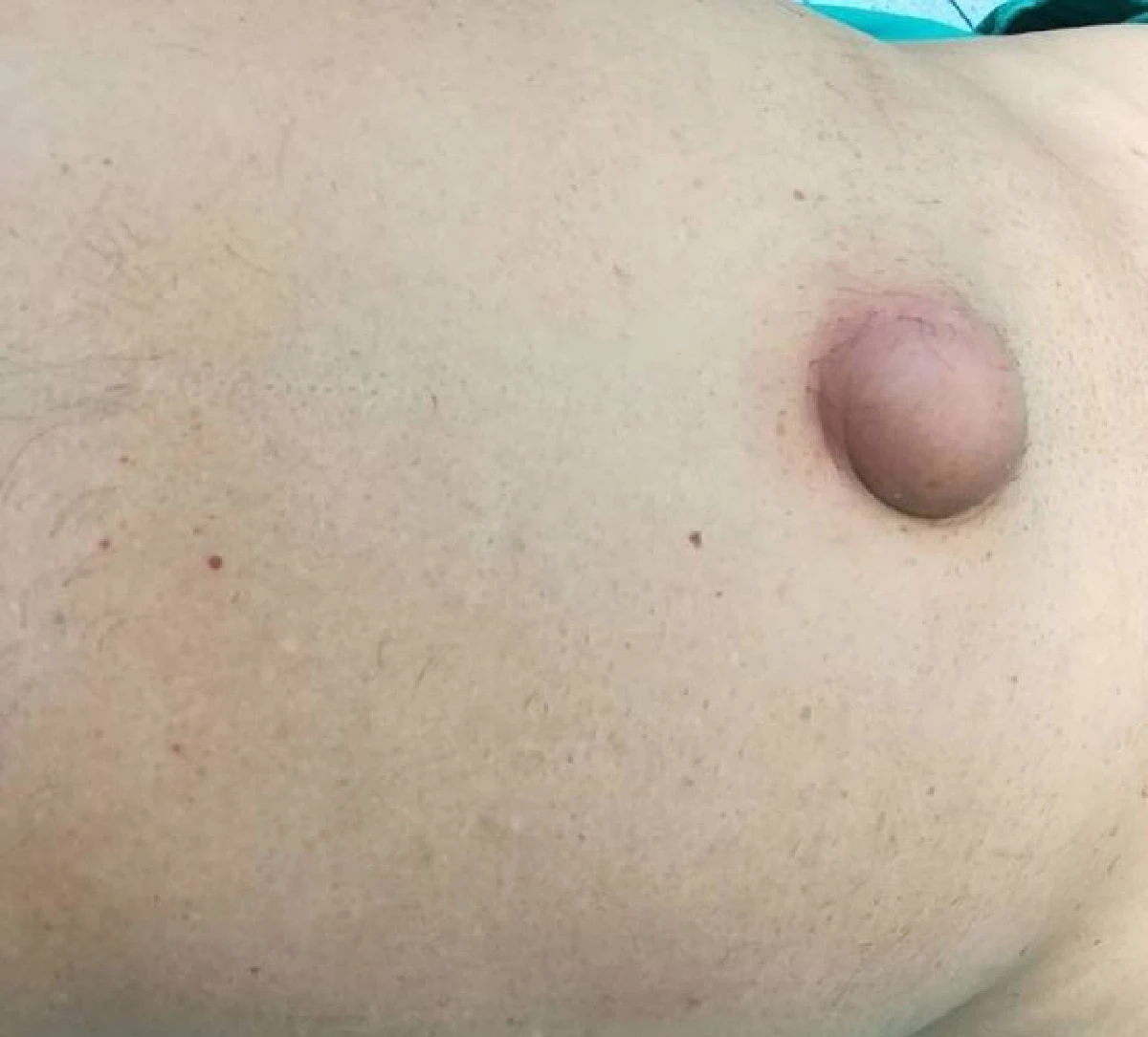 เตือนภัย "สะดือจุ่น" มัจจุราชเงียบทำลำไส้อุดตันถึงตาย