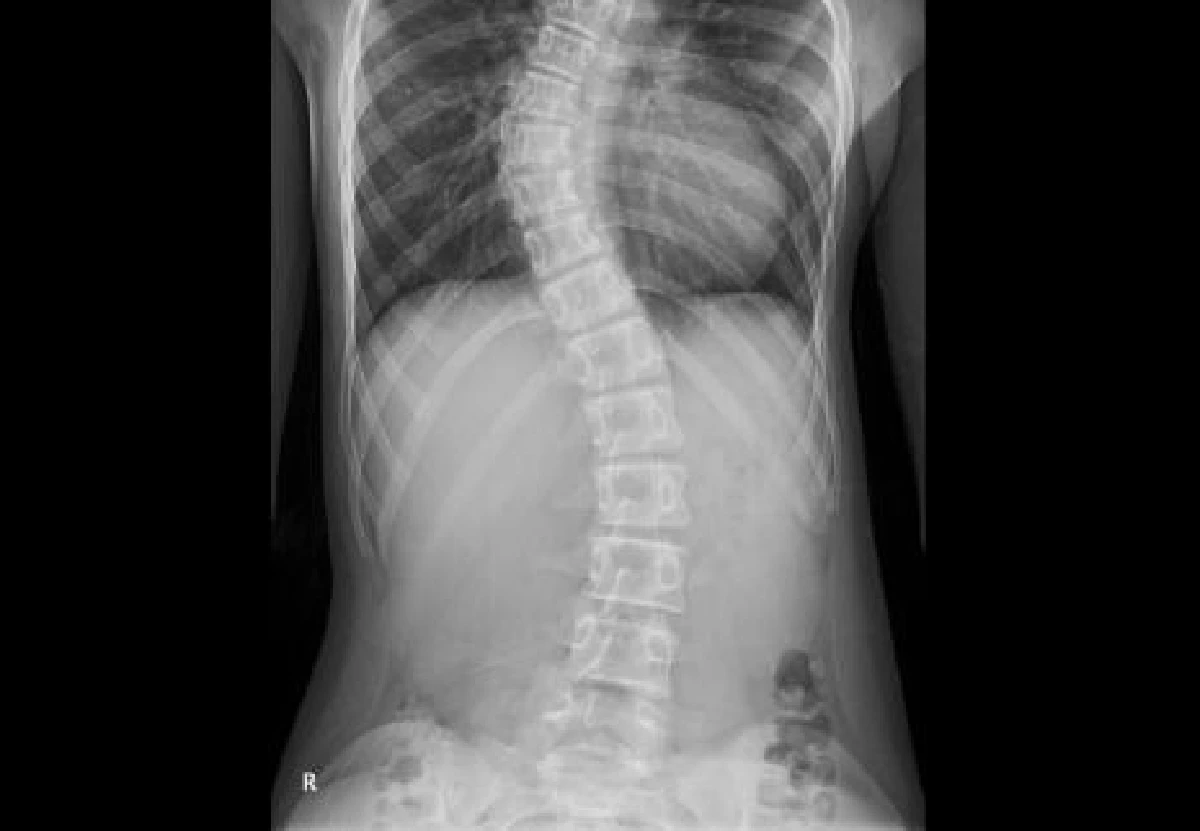 หมั่นสังเกตกระดูกสันหลังเด็ก! แม่แชร์นาทีลูกสาว 11 ขวบสู้โรคกระดูกสันหลังคด