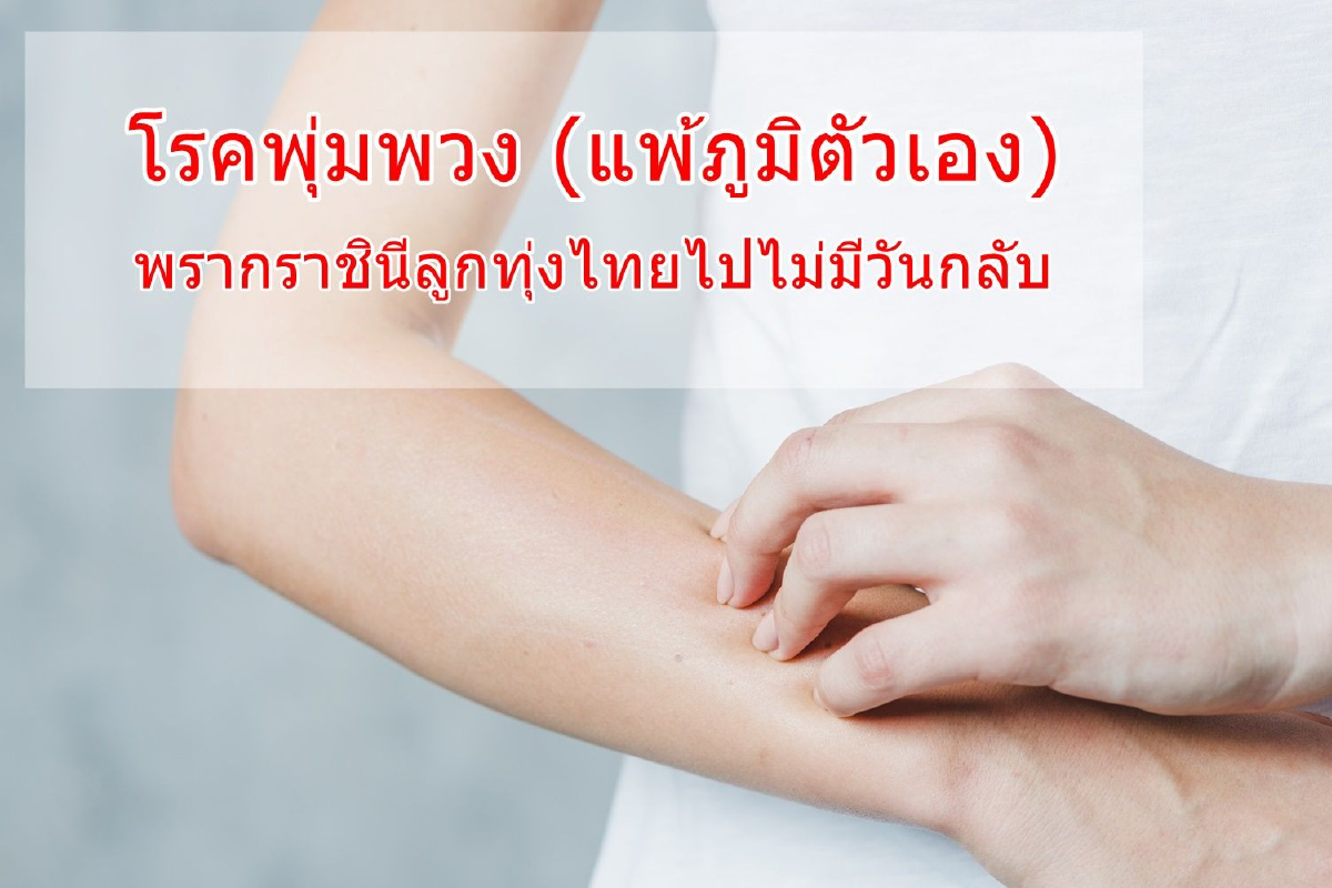 โรคพุ่มพวง (แพ้ภูมิตัวเอง) โรคที่พรากราชินีลูกทุ่งไทยไปอย่างไม่มีวันกลับ โรคพุ่มพวง (แพ้ภูมิตัวเอง) โรคที่พรากราชินีลูกทุ่งไทยไปอย่างไม่มีวันกลับ