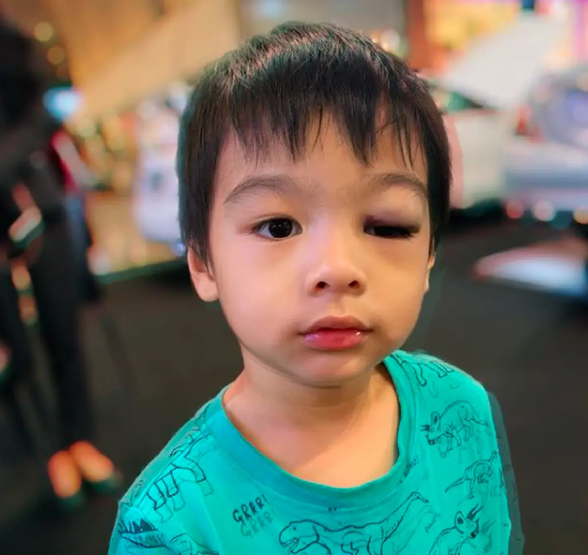 "น้องโอลาฟ" ตกจากที่สูง 2 เมตร ตาบวมม่วงจนปิด "จีน่า-โอ๊ต" เผยเหตุจากความซน