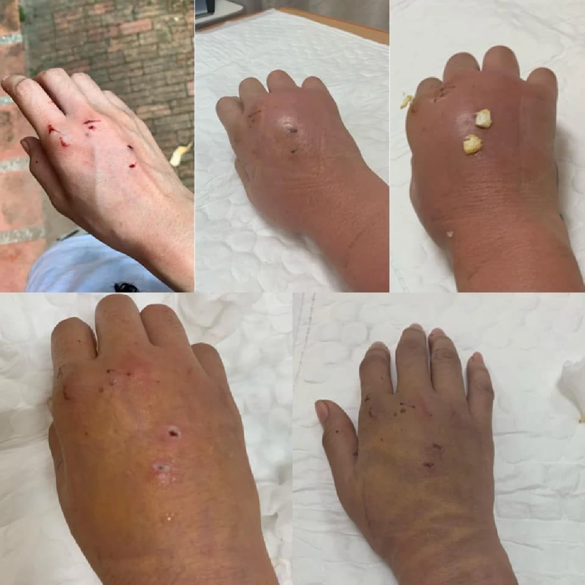 "แมวกัดไม่ใช่เรื่องเล่น" สาวเผยประสบการณ์สุดทรมานเกิดแผลติดเชื้อในกระแสเลือด