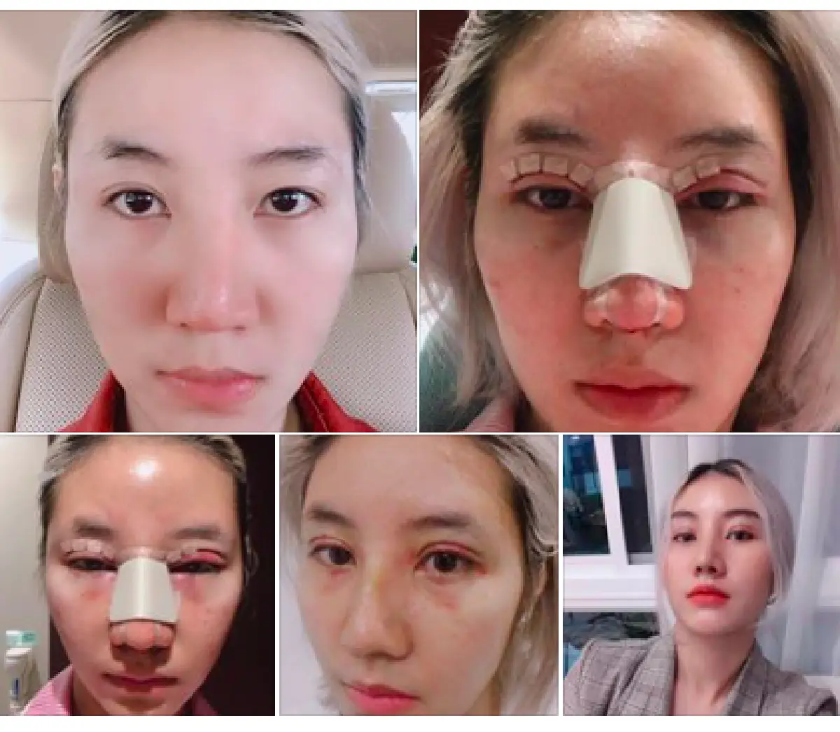 ส่องภาพสุดแซ่บ "ต้องตา แสงรวี" น้องสาว “โตโน่” หลังบินไปศัลยกรรมที่เกาหลี