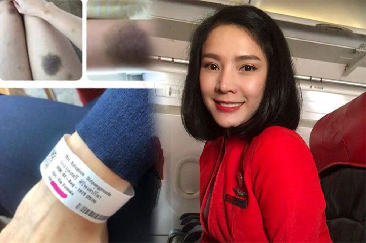 "นิ้ง กุลสตรี” ป่วยเป็นโรคแปลกผิวหนังมีรอยช้ำเป็นจ้ำ แถมยังระบุไม่ได้ว่าเป็นอะไร "นิ้ง กุลสตรี” ป่วยเป็นโรคแปลกผิวหนังมีรอยช้ำเป็นจ้ำ แถมยังระบุไม่ได้ว่าเป็นอะไร