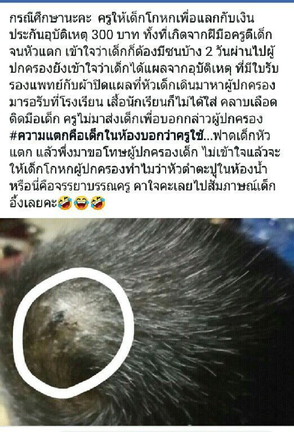 ฉาวอีก! ครูตีหัว ป.1 เลือดอาบแต่ให้โกหกโดนตะปูตำหวังเงินประกัน 300