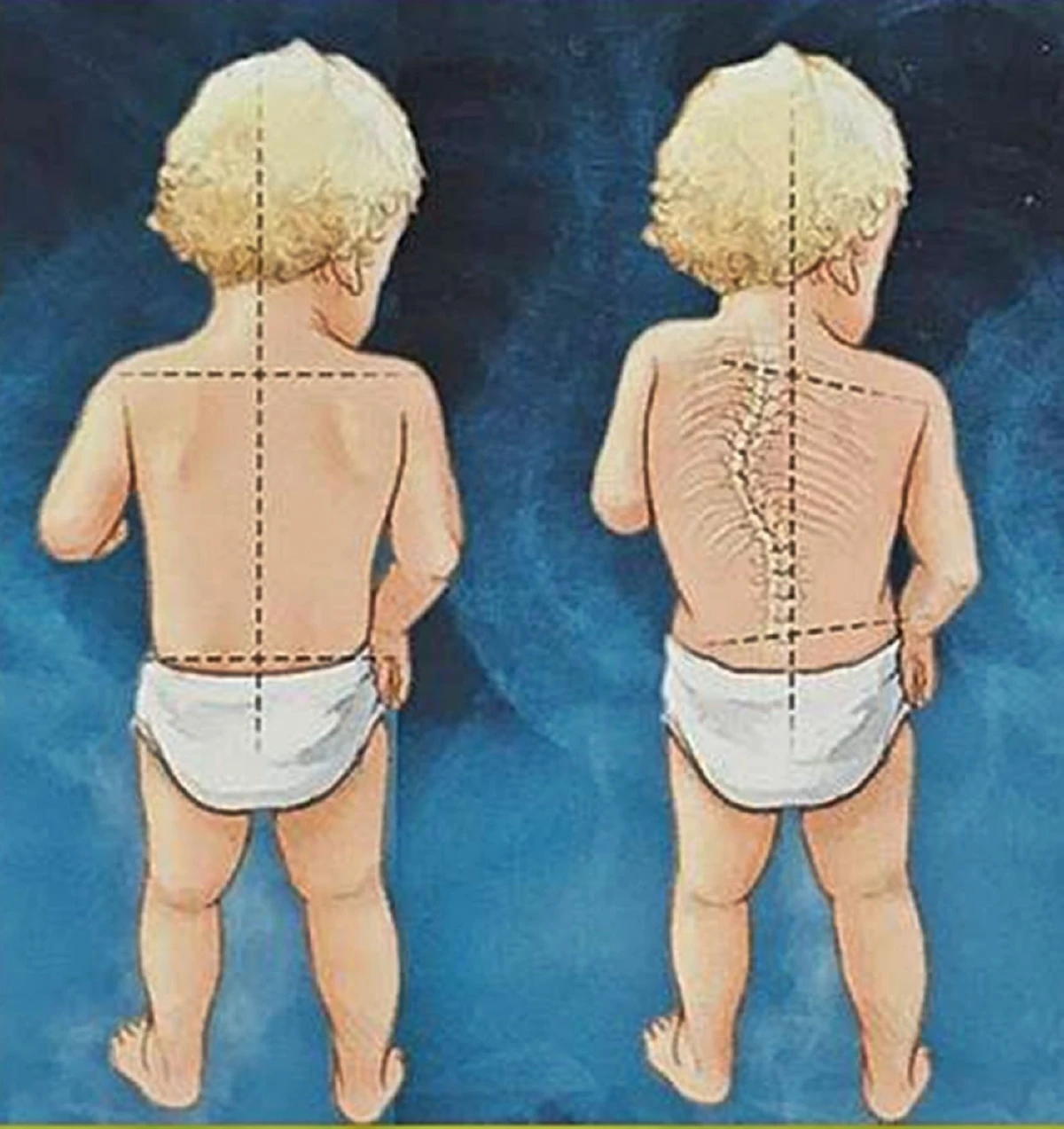 กระดูกสันหลังคดในเด็ก สัญญาณเตือนที่พ่อแม่ควรสังเกต พร้อมแนวทางแก้จาก รมช.ศึกษาธิการ