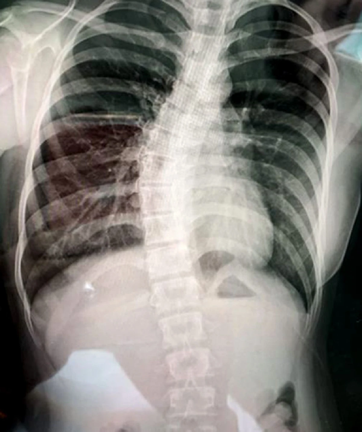 กระดูกสันหลังคดในเด็ก สัญญาณเตือนที่พ่อแม่ควรสังเกต พร้อมแนวทางแก้จาก รมช.ศึกษาธิการ