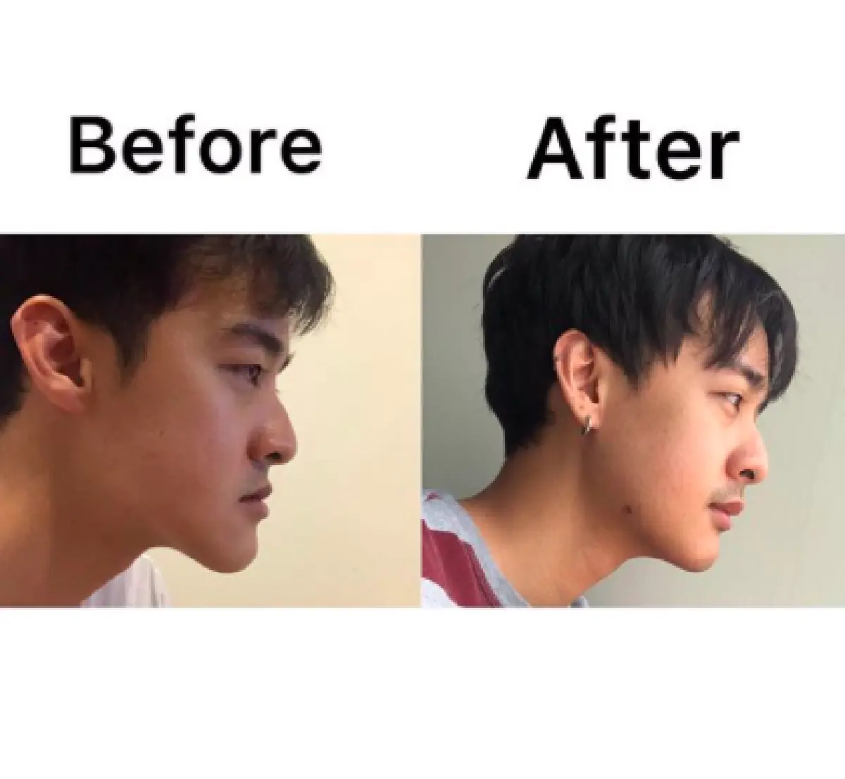 "หม่อมเอ็ม” เผยภาพก่อน-หลัง ให้เห็นชัดๆ หลังศัลยกรรมกระดูกขากรรไกร