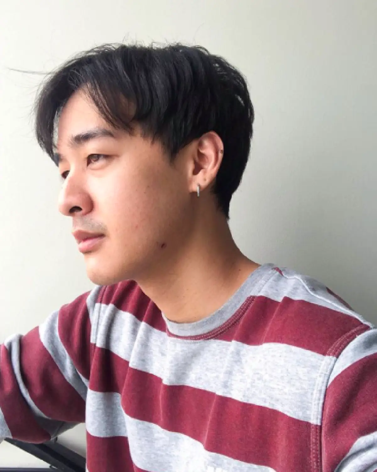 "หม่อมเอ็ม” เผยภาพก่อน-หลัง ให้เห็นชัดๆ หลังศัลยกรรมกระดูกขากรรไกร