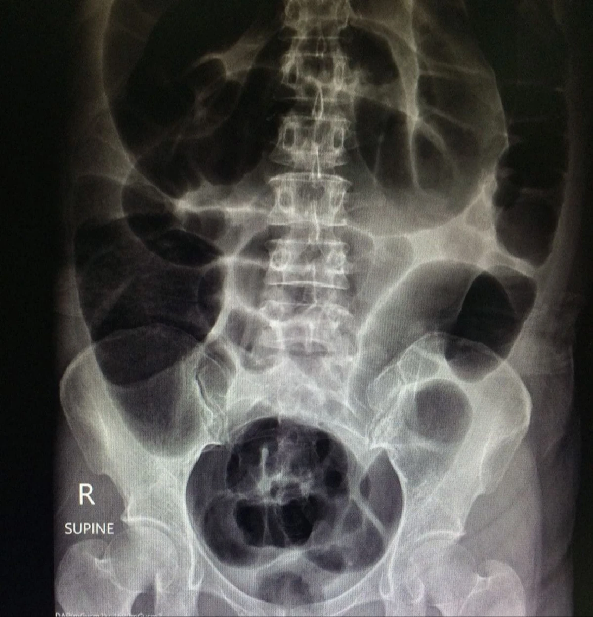 ต้องตัดลำไส้บางส่วน! ผอ.รพ.สิชล เตือน "ท้องผูกเรื้อรัง" ไม่ใช่ภาวะปกติ