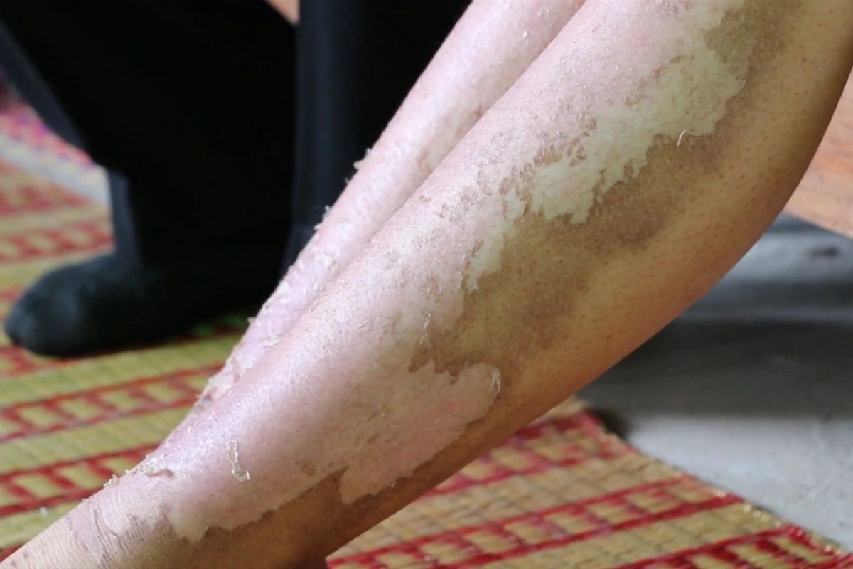 สพม.เขต25สอบครูให้นักเรียนเผาถ่านแก้ตกวิชาฟิสิกส์เป็นเหตุให้ลูกศิษย์ถูกไฟคลอกสาหัส