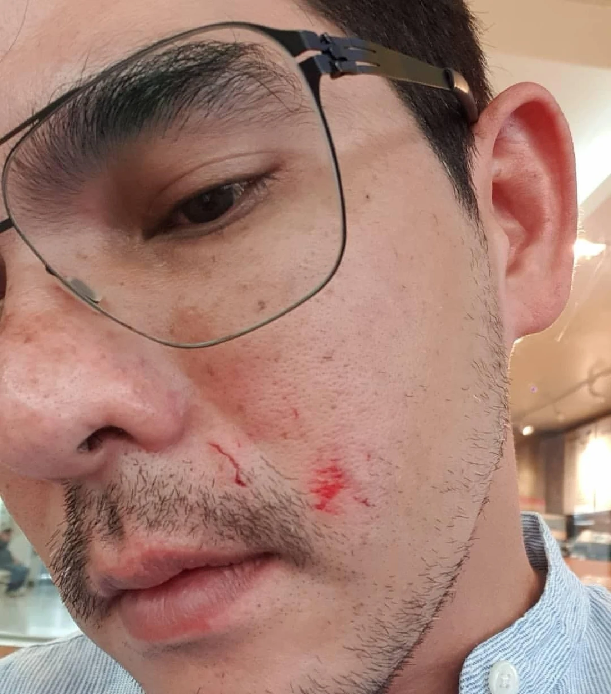 “บิ๊ก ศรุต” เผยสาเหตุที่มาบาดแผลที่หน้า ถูกสุนัขที่บ้านกัด