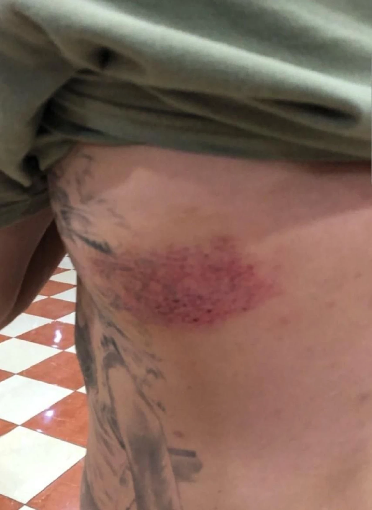 ทำงานหนักไปนิด! "สงกรานต์" เดินตกช่องบันได ได้รอยแดงช้ำเลือดขนาดใหญ่ข้างลำตัว