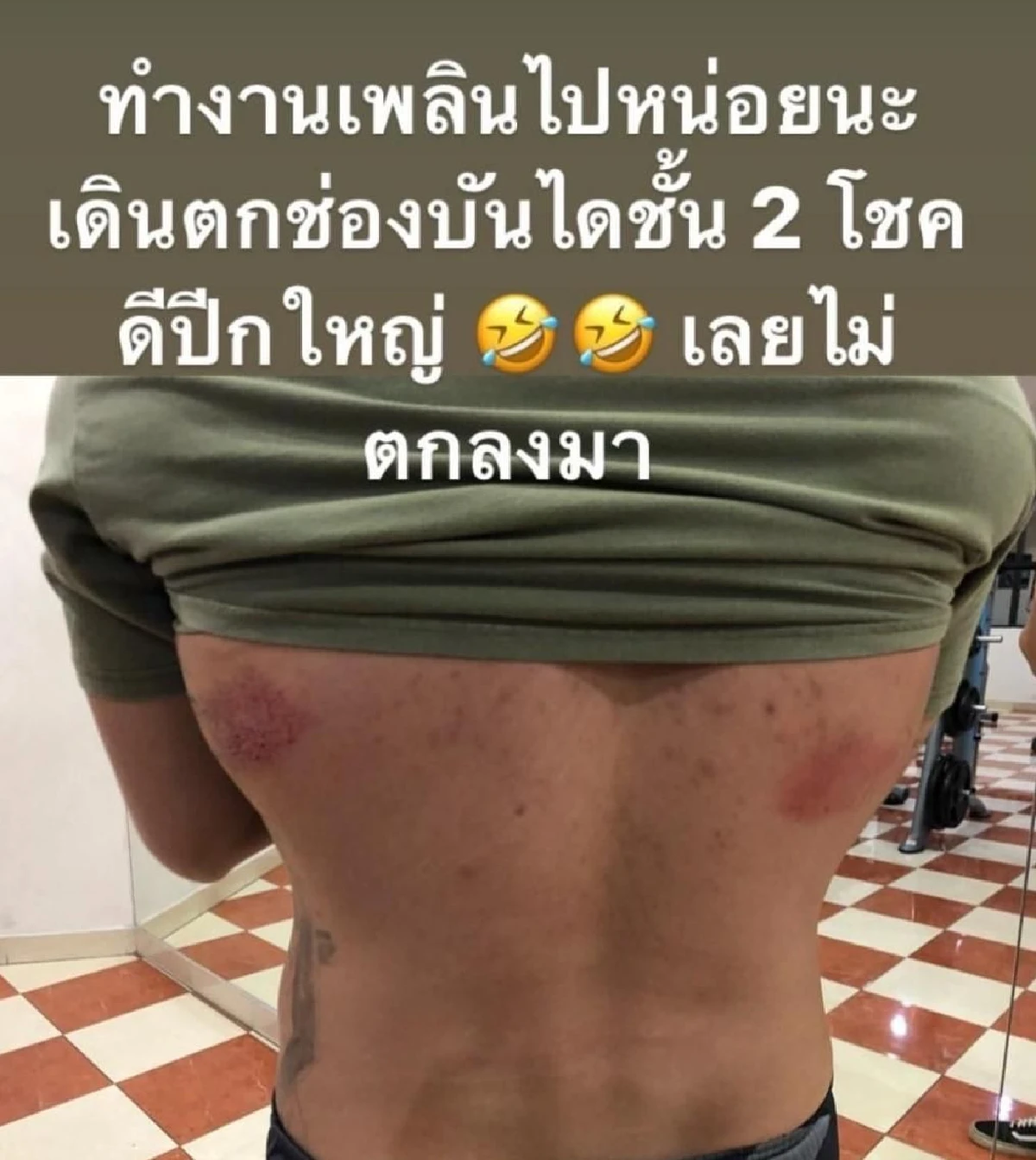 ทำงานหนักไปนิด! "สงกรานต์" เดินตกช่องบันได ได้รอยแดงช้ำเลือดขนาดใหญ่ข้างลำตัว