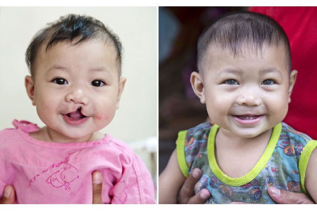 ปีใหม่นี้ส่งความสุขมอบของขวัญเพื่อน้องปากแหว่งเพดานโหว่ “เติมรอยยิ้มไปด้วยกัน” เมื่อการให้และส่งต่อ คือสิ่งที่เราทำให้ได้กับสังคมและโลกใบนี้ ปีใหม่นี้ส่งความสุขมอบของขวัญเพื่อน้องปากแหว่งเพดานโหว่ “เติมรอยยิ้มไปด้วยกัน” เมื่อการให้และส่งต่อ คือสิ่งที่เราทำให้ได้กับสังคมและโลกใบนี้