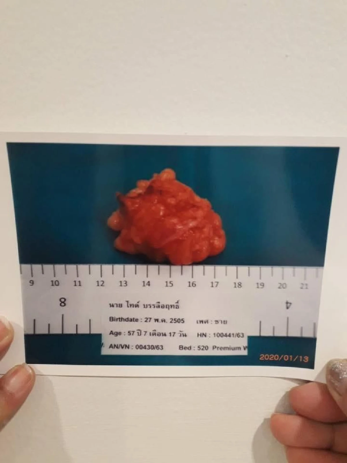 แฟนคลับแห่ส่งกำลังใจถึง "ไทด์ เอกพันธ์” หลังผ่าตัดก้อนเนื้อใต้หัวไหล่