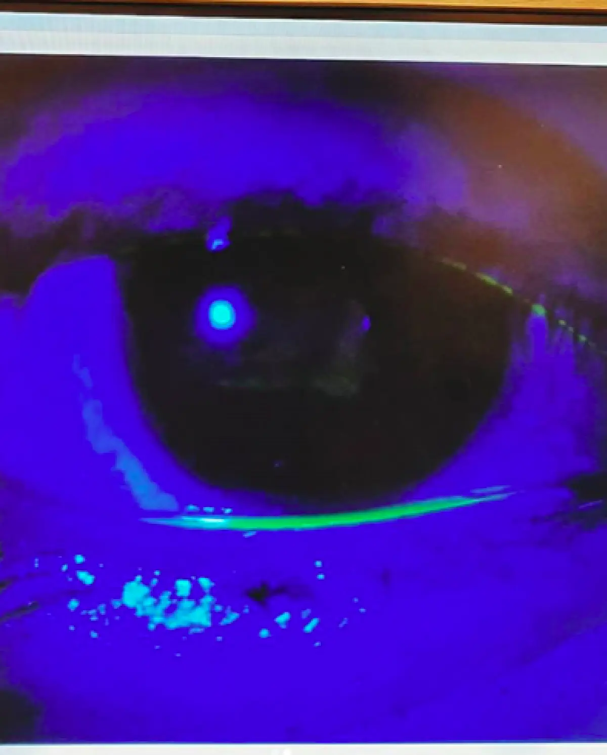 หวิดตาบอด “ก้อย รัชวิน” เล็บข่วนกระจกตา! ด้าน “ตูน บอดี้สแลม” ดูแลดีไม่ห่าง