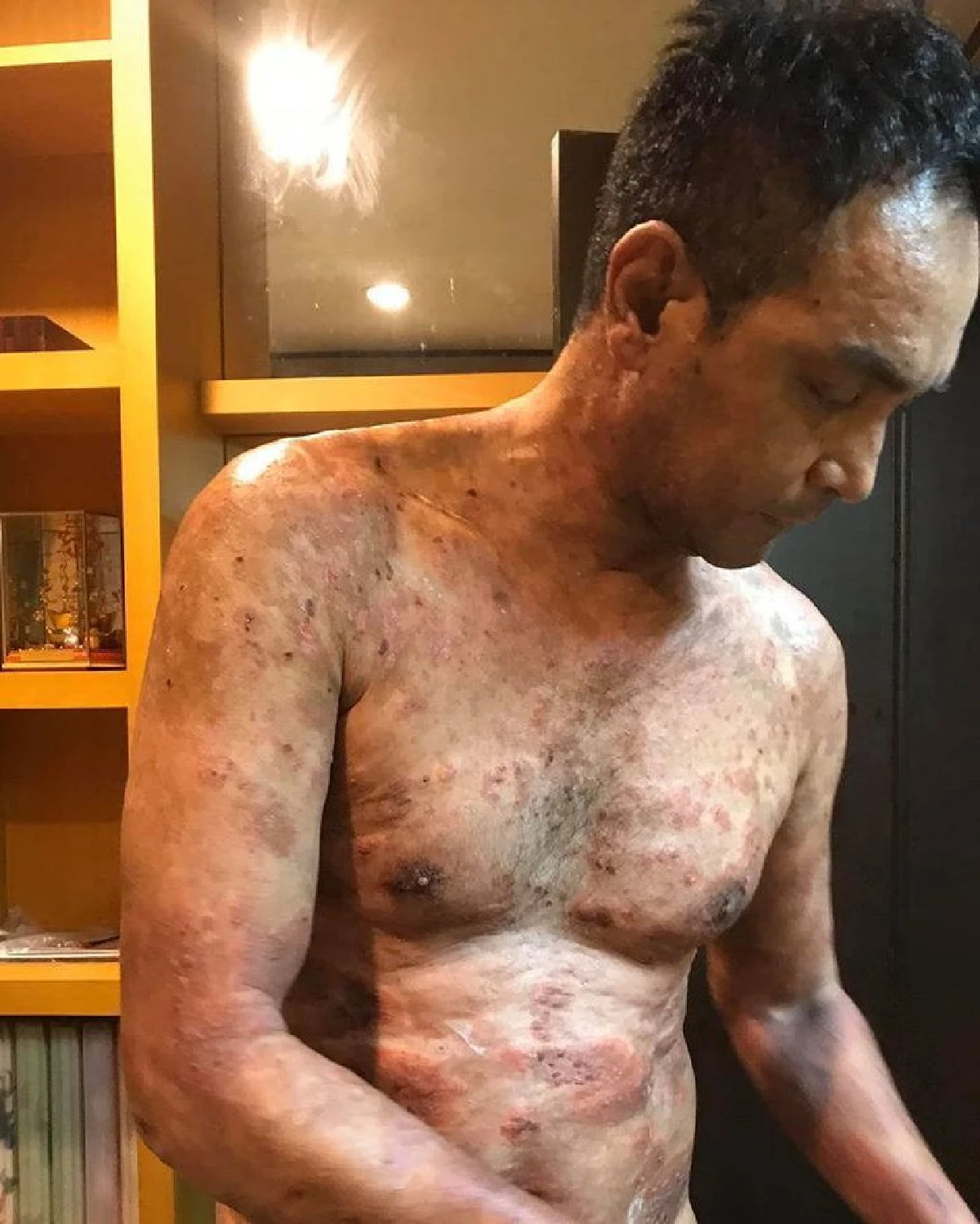 เจ็บแต่ต้องทน! วินัย ไกรบุตร เจอพิษฝุ่นทำอาการตุ่มน้ำพองกำเริบหนัก