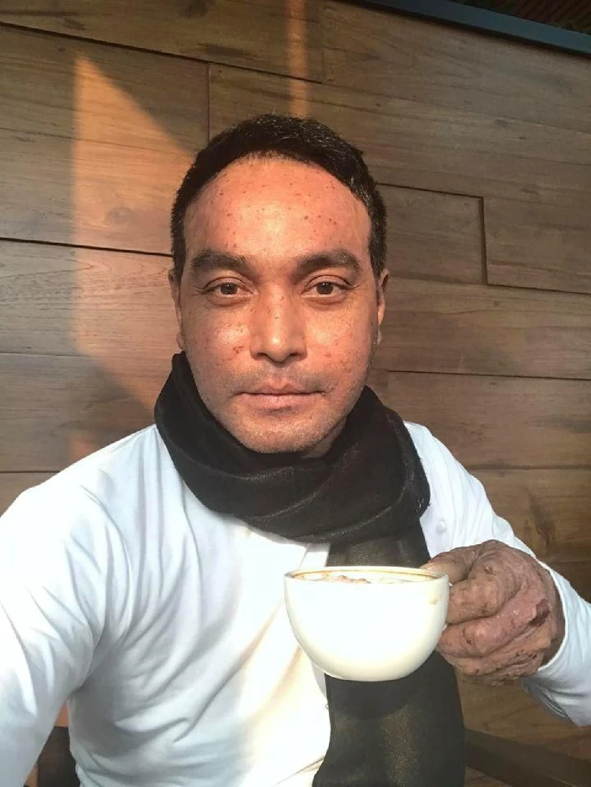 เจ็บแต่ต้องทน! วินัย ไกรบุตร เจอพิษฝุ่นทำอาการตุ่มน้ำพองกำเริบหนัก