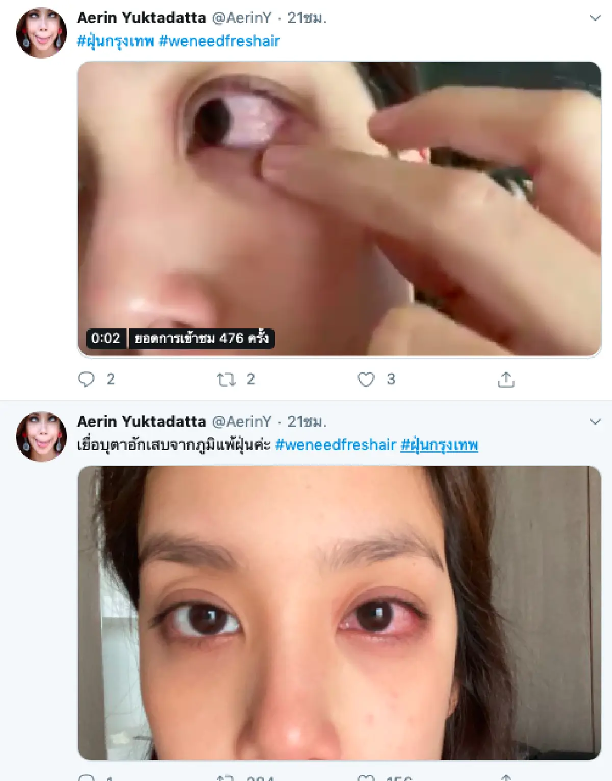 พิษฝุ่น PM 2.5 ทำ “แอริน ยุกตะทัต” ดวงตาอักเสบแดง