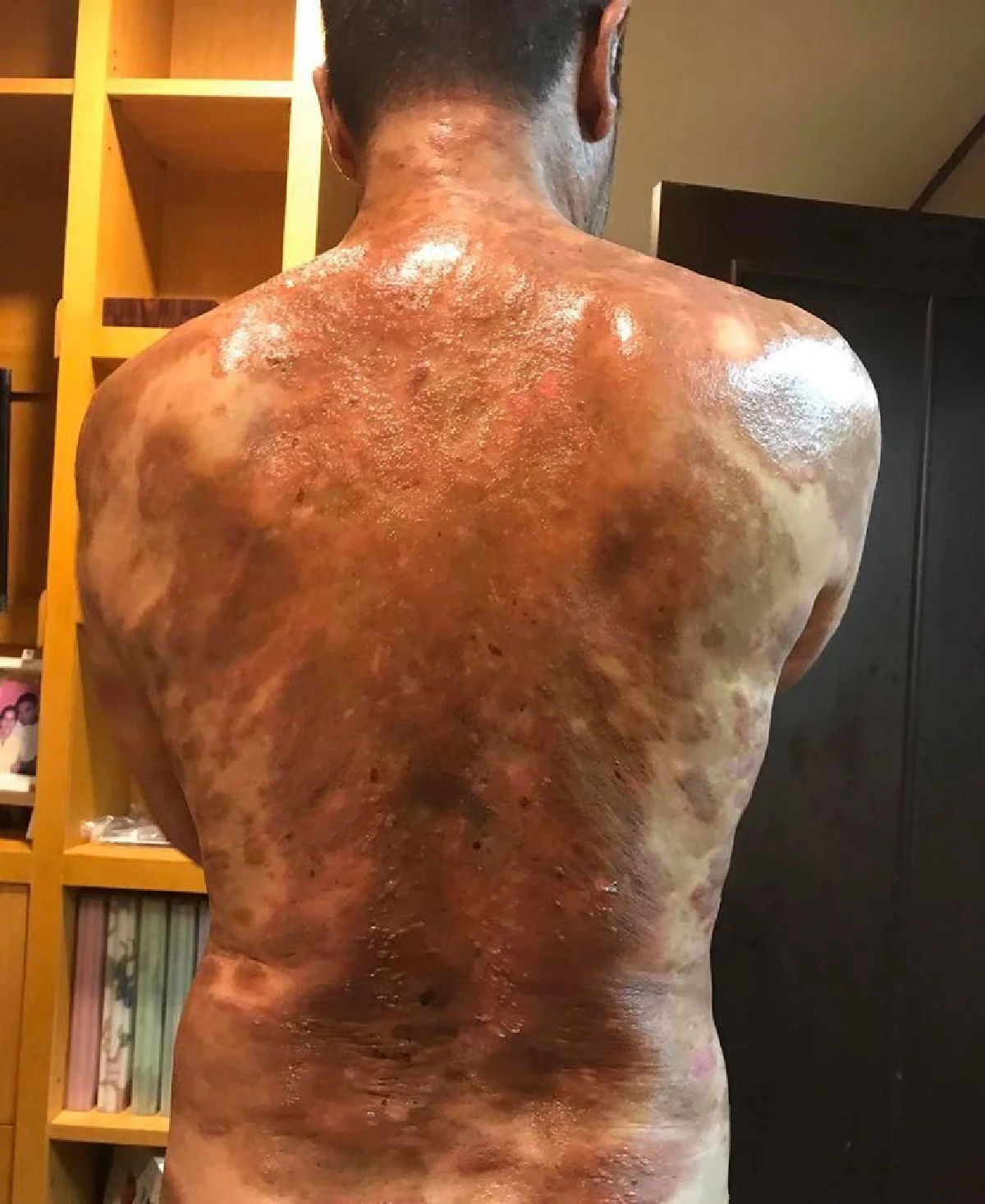 เจ็บแต่ต้องทน! วินัย ไกรบุตร เจอพิษฝุ่นทำอาการตุ่มน้ำพองกำเริบหนัก