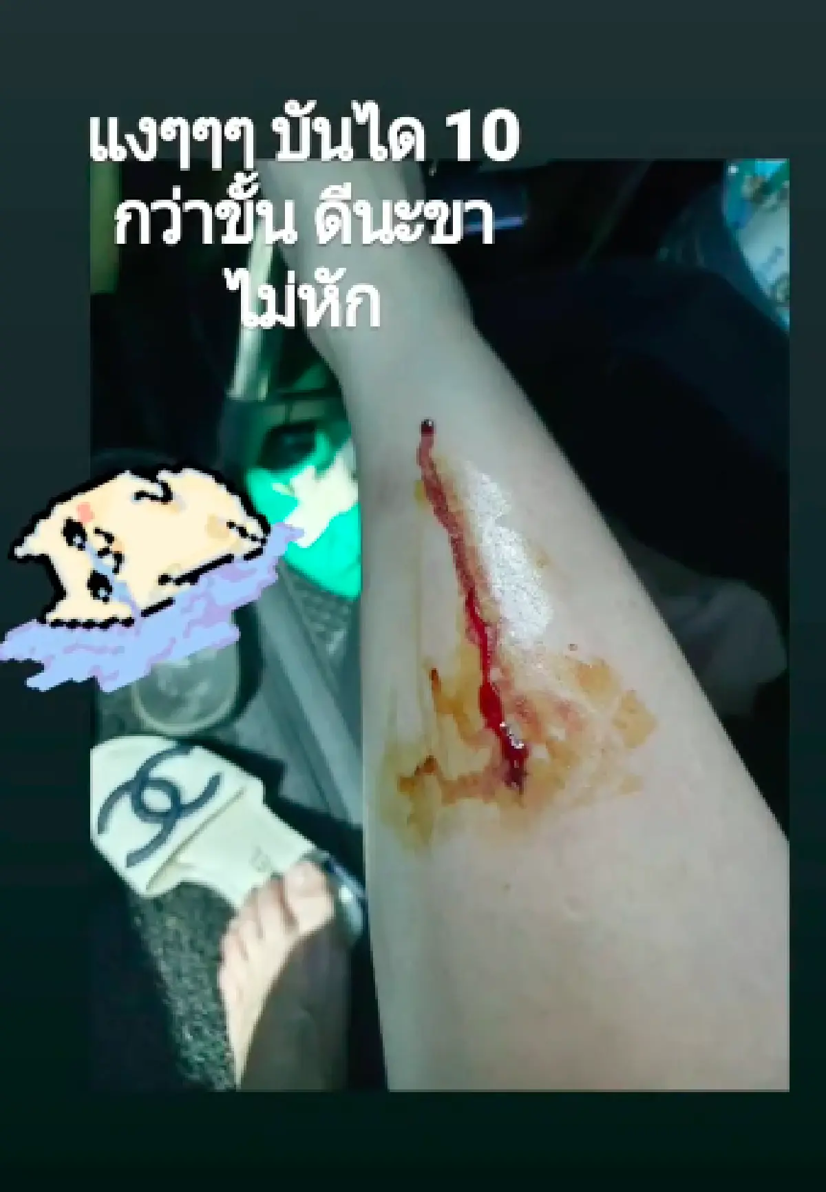 "ออม สุชาร์" ทำแฟนคลับช็อก! ตกบันได 10 กว่าขั้นเลือดอาบเลยทีเดียว 