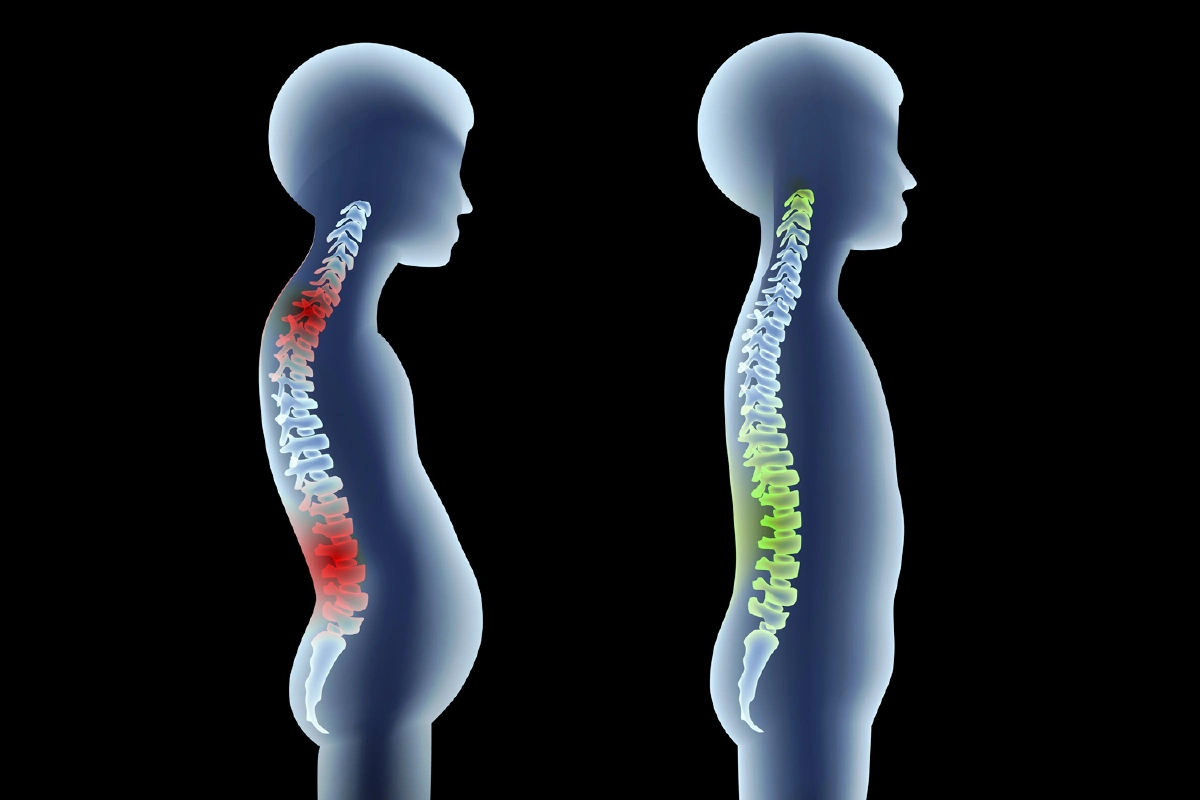 ปัญหากระดูกสันหลังคดในเด็ก รักษาอย่างไรให้ถูกวิธี