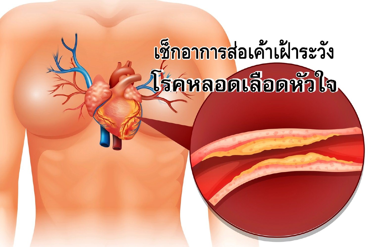เช็กอาการส่อเค้าเฝ้าระวังของโรคหลอดเลือดหัวใจ เช็กอาการส่อเค้าเฝ้าระวังของโรคหลอดเลือดหัวใจ